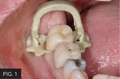Placing anchor clamp into molar
