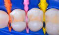 Bioclear Diamind Wedges