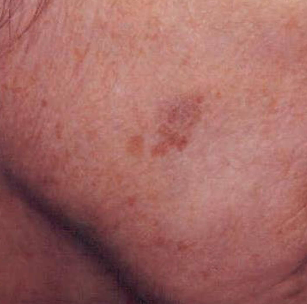 Intense Pulsed Light Pigmentation Removal Before