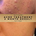 Personalised Skincare for Acne Dr Sknn Before & After Picture