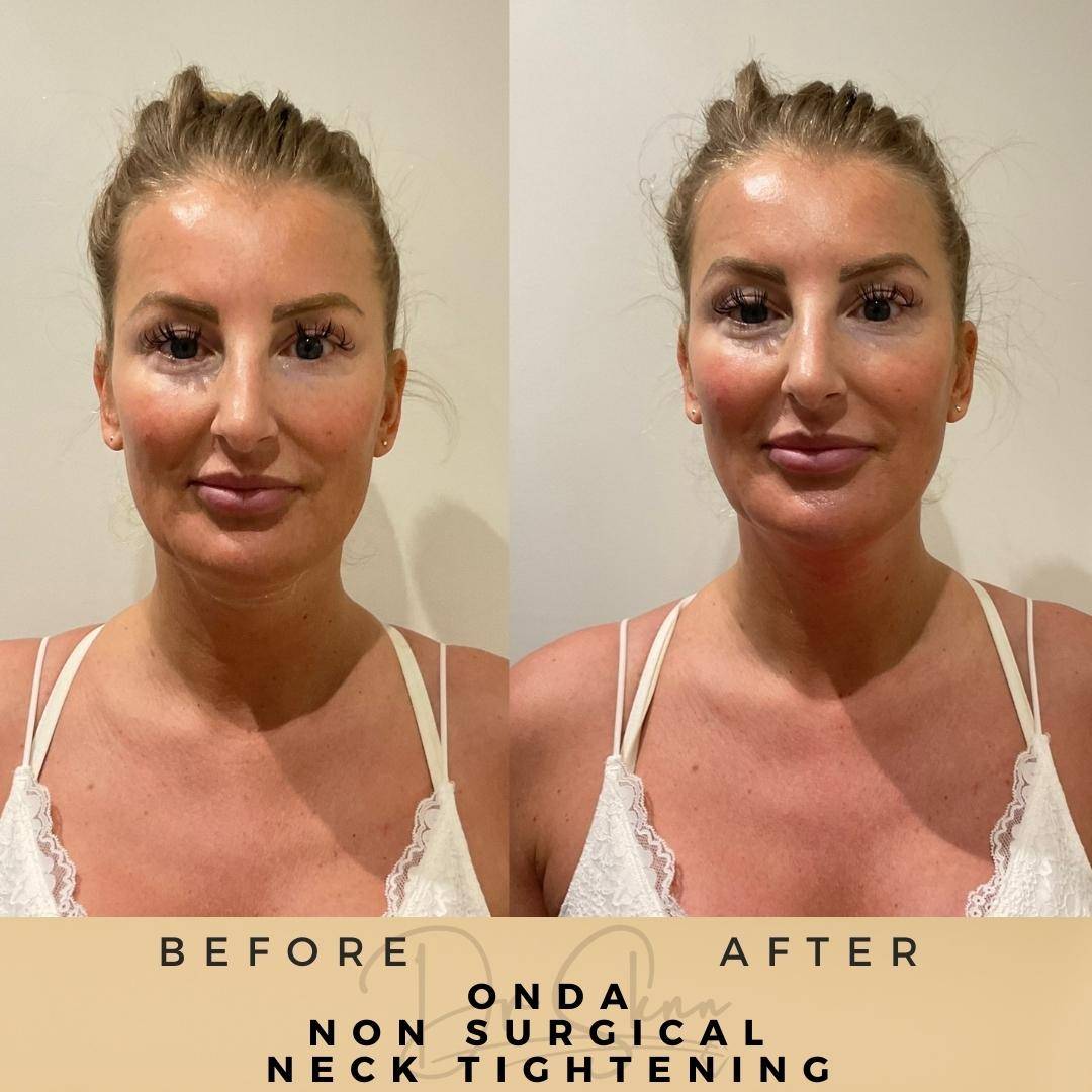 Neck Tightening Treatment - Dr Sknn before and after