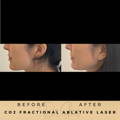Pigmentation Treatment Co2 Fractional Laser Wilmslow Dr Sknn Before & After Picture
