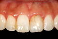Anterior teeth with one cracked tooth
