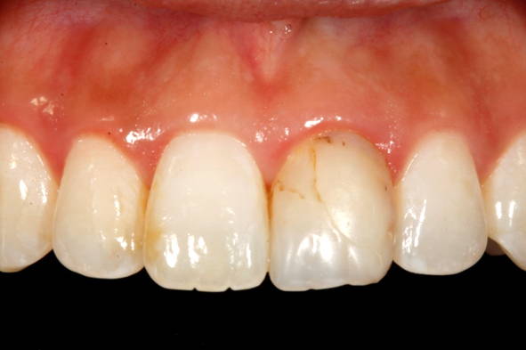 Anterior teeth with one cracked tooth