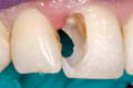 Deep Class IV Restoration: before the Bioclear Method