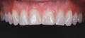 Patient's upper teeth