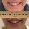 Gummy Smile Correction Fillers Before & After