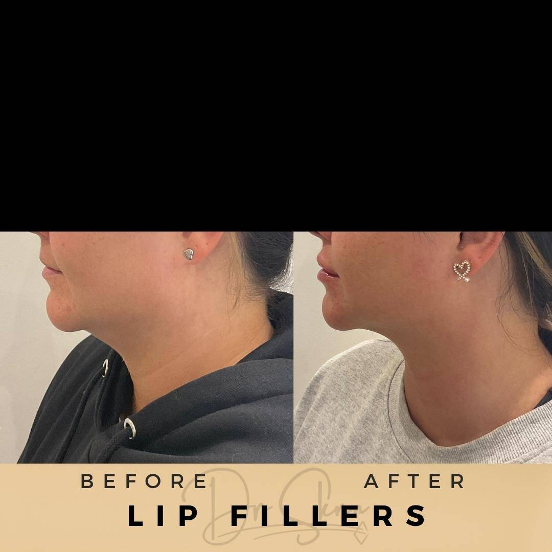 Lip Fillers Wilmslow Before & After Dr Sknn