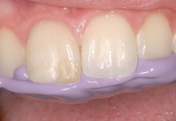 teeth biting into purple matrix material
