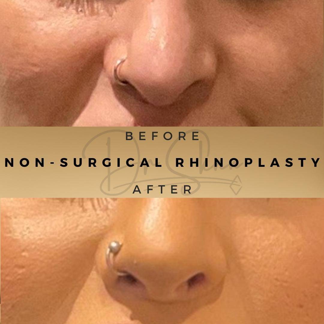 Non Surgical Rhinoplasty Wilmslow Before & After Dr Sknn