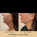 Jawline fillers Dr Sknn Before & After Picture