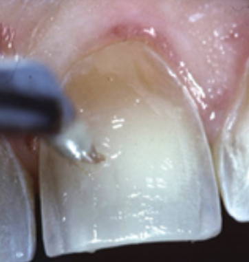 A thin layer of Creative Color Clear Liquid Resin has been applied to the prepped tooth.