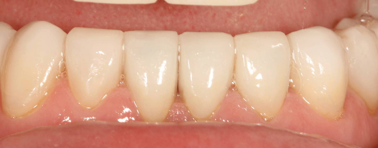 Teeth after being filled with core material