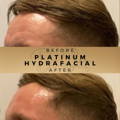 Platinum Hydrafacial Wilmslow Before and After Dr Sknn Cheshire