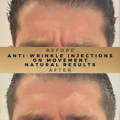 Frown Line Anti-Wrinkle Injections Wilmslow