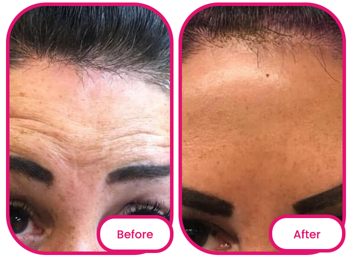 the forehead before and after taking the best collagen gummies singapore