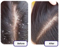 removal of dandruff user of our best vitamins for hair growth