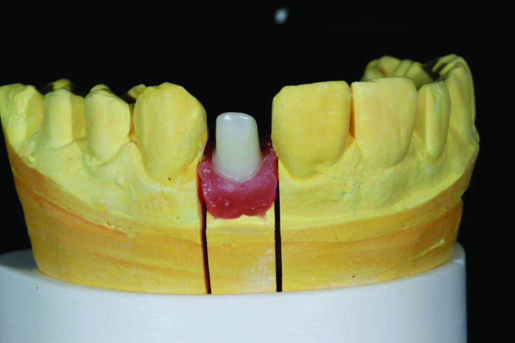 Yellow zirconia abutment with soft tissue model