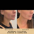 Jaw Fillers Wilmslow Before & After Dr Sknn