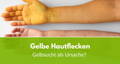 gelbe hautflecken