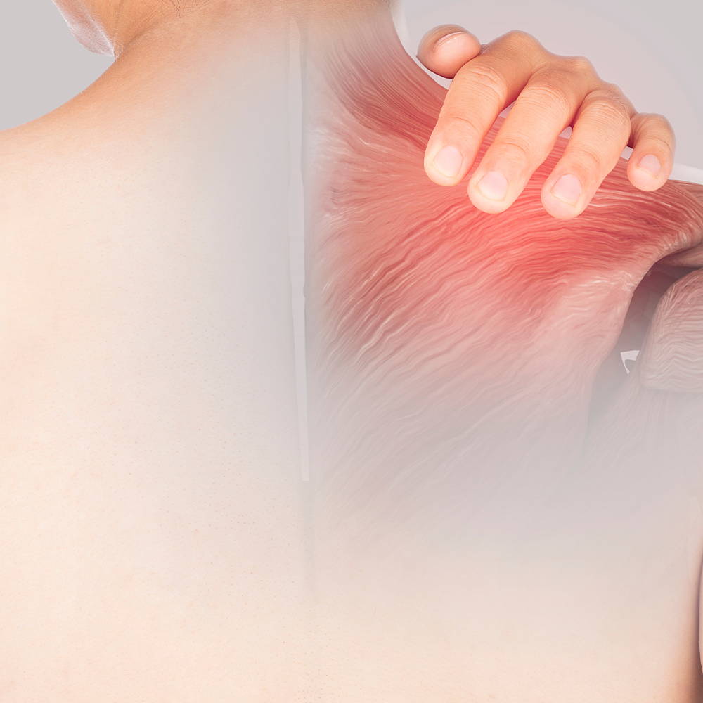Lumbar Strain & Sprain Illustration