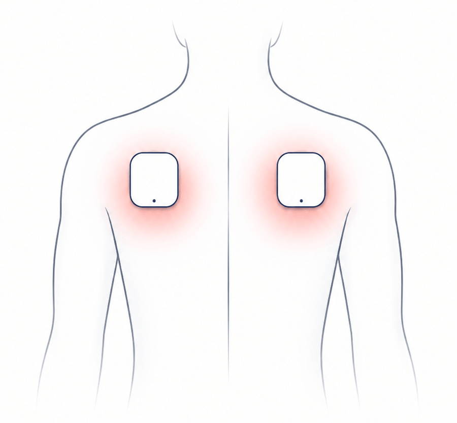 Two-channel TENS setup treating two areas at the same intensity.