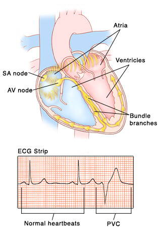 Contractions ventriculaires prématurées (PVC)