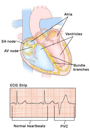 Premature Ventricular Contractions (PVC)