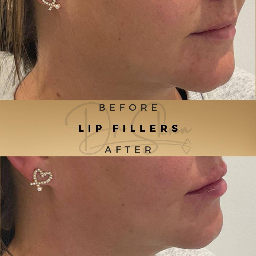 Lip Fillers Wilmslow Before & After Dr Sknn