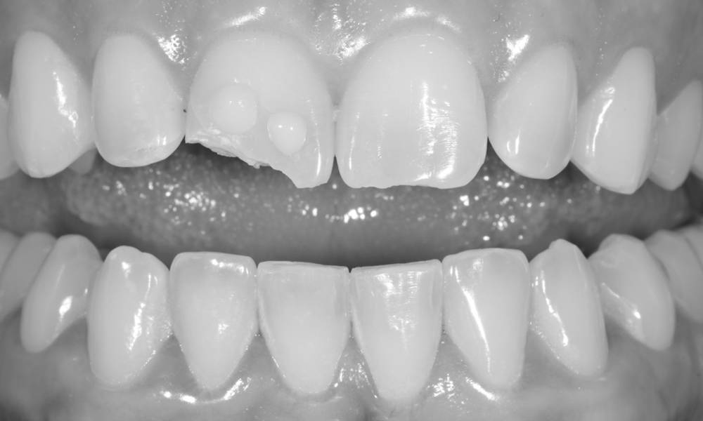 black and white smile with fractured upper central incisor