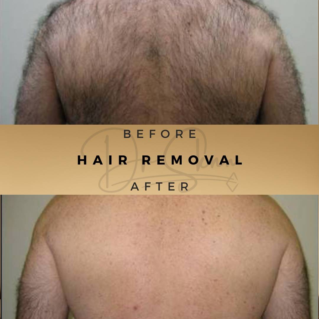 Laser Hair Removal