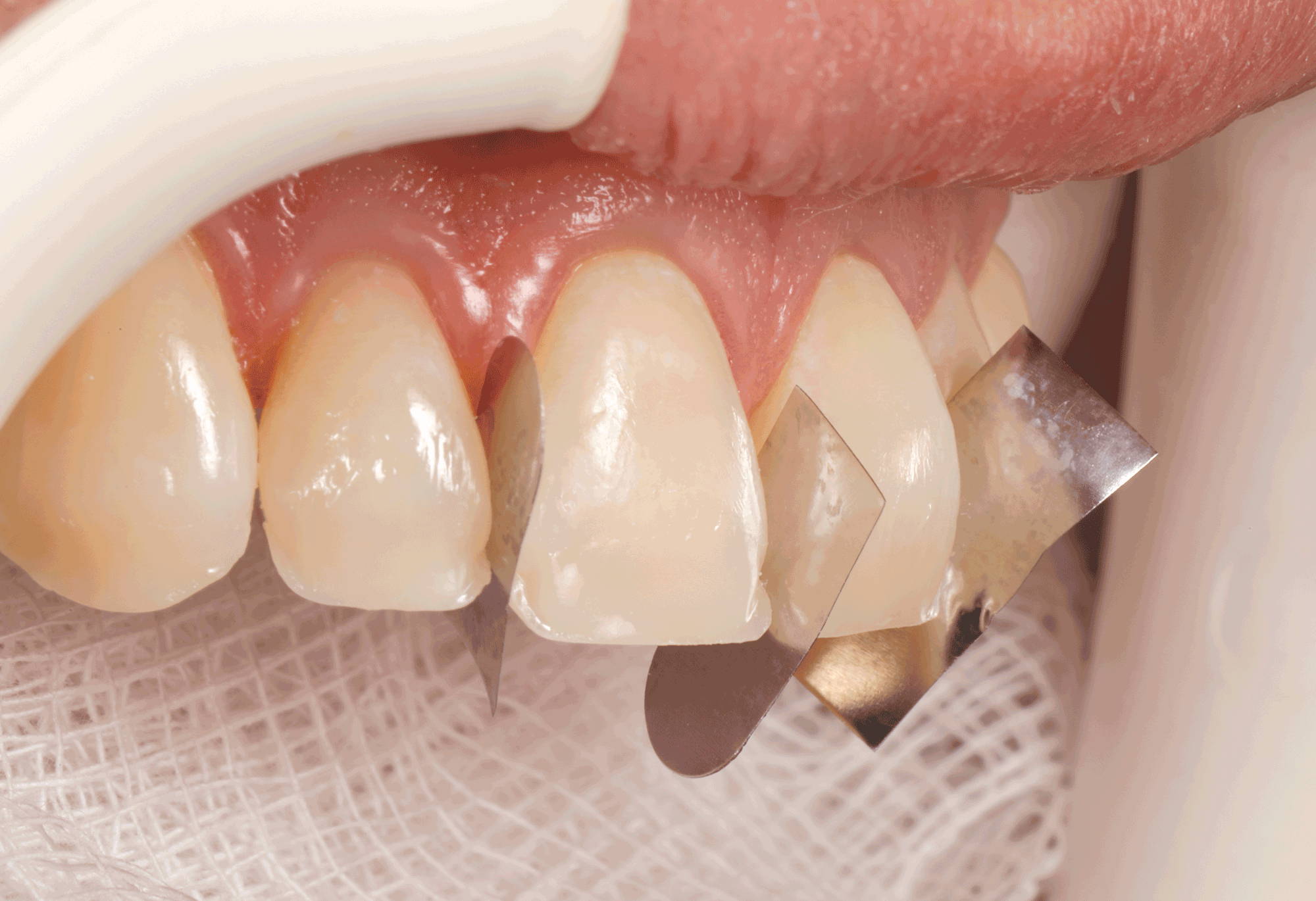 upper teeth with metal pieces in between