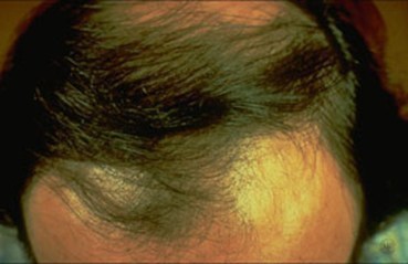 Dr. Kaplan – Hair Loss Treatment - KAPLAN MD SKINCARE