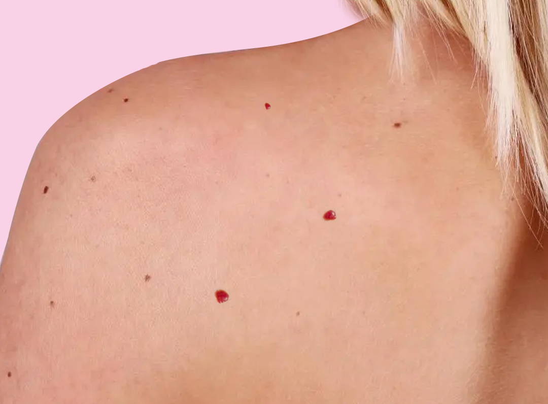 Skintify™ Remover Pen for Cherry Angiomas