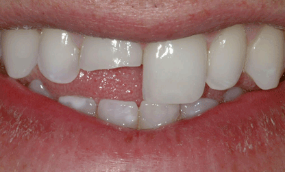 Bioclear Class IV: before and after