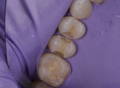 Pre-molars isolated with purple rubber dam showing removed decay