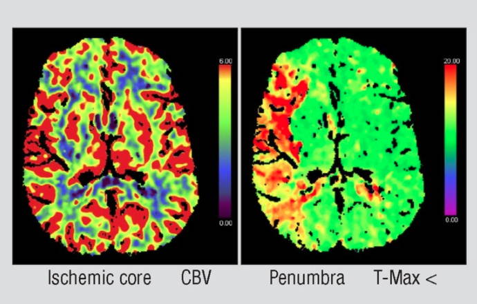 neurovascular disease image