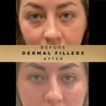 Cheek Fillers Wilmslow