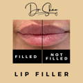 Lip Fillers Wilmslow with Anti-wrinkle injections