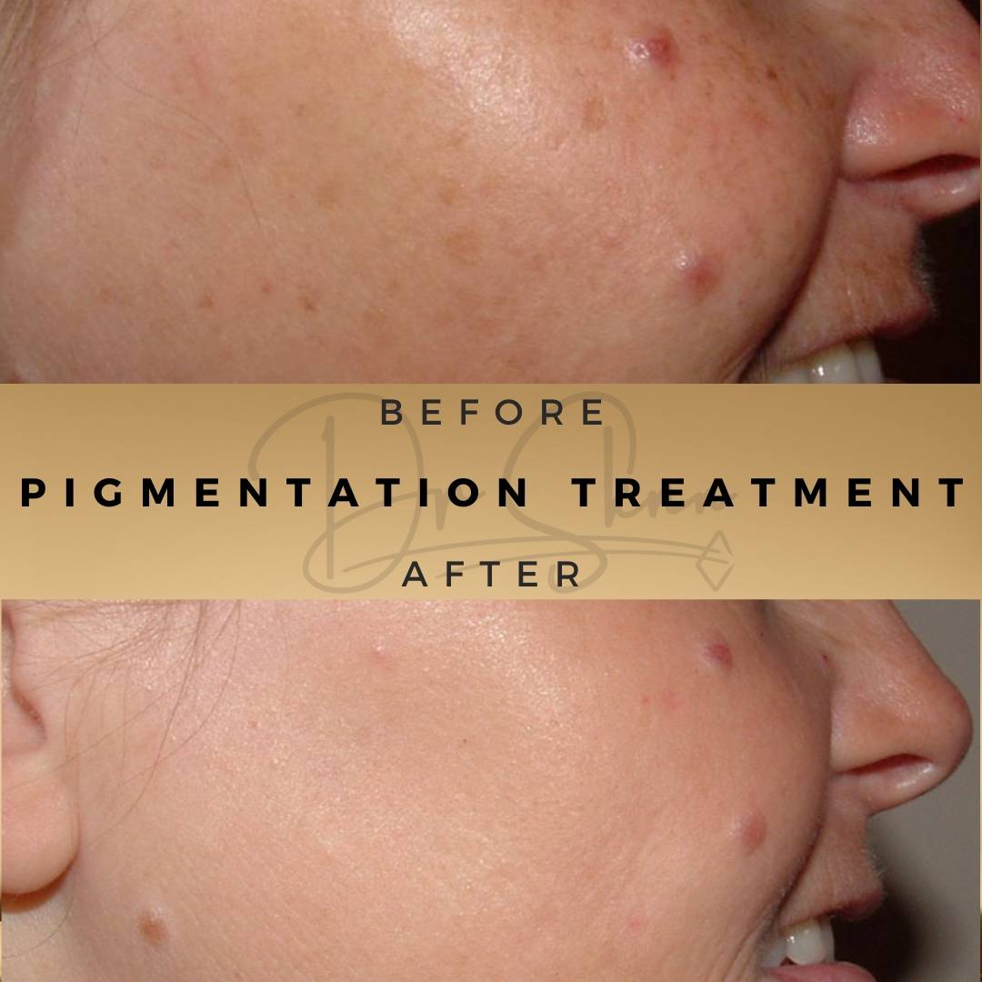 Pigmentation Treatment Wilmslow Before & After Dr Sknn