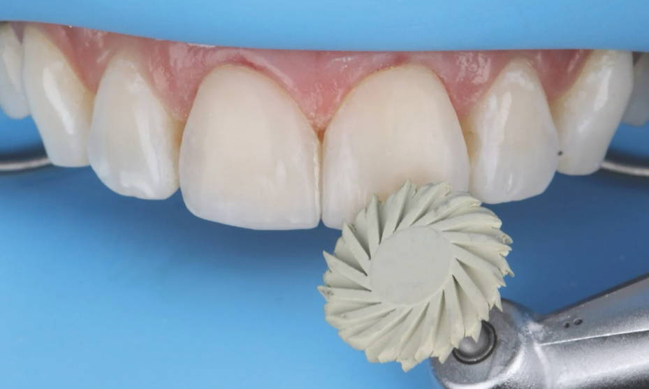 grey polisher touching tooth