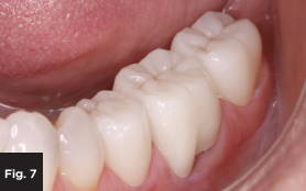 a finished, cleaned and cured monolithic zirconia crown in a patient mouth, labial view