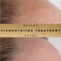 REMOVE AGE SPOTS Before & After Picture