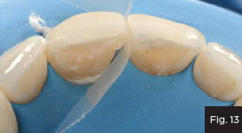 Ideal proximal contact and gingival embrasure were established using the pull-through technique
