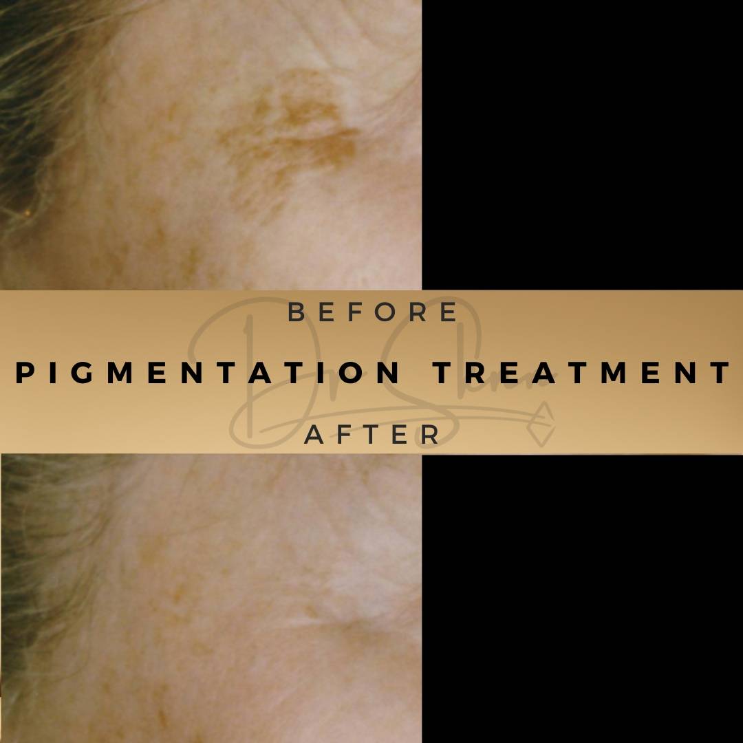 Pigmentation Treatment Wilmslow Before & After Dr Sknn