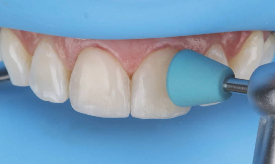 Polishing cup polishing tooth
