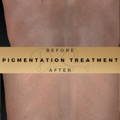 Pigmentation Treatment Wilmslow Dr Sknn Before & After Picture