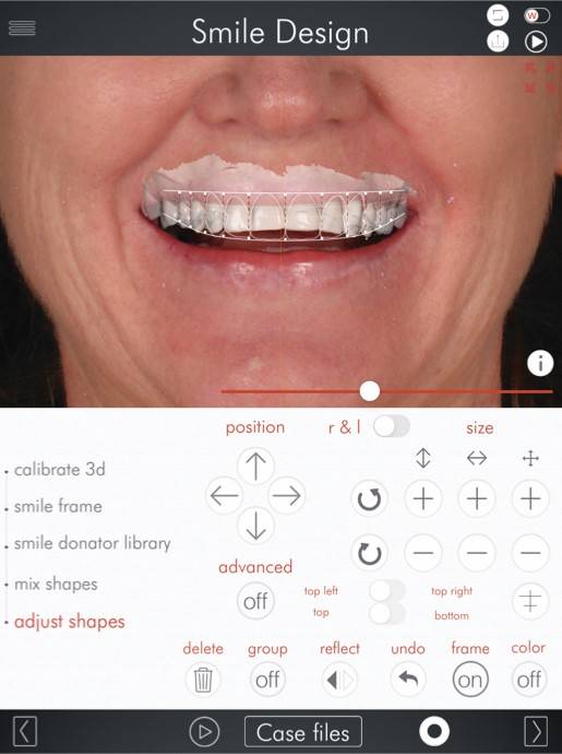 Digital application projecting patient's new smile