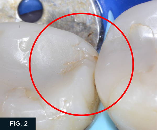 We see the tooth has been pre-wedged with the extra-large Diamond wedge which should be part of every class two composite and should be part of every class two crown preparation. The circled area contains the cracked surface composite.