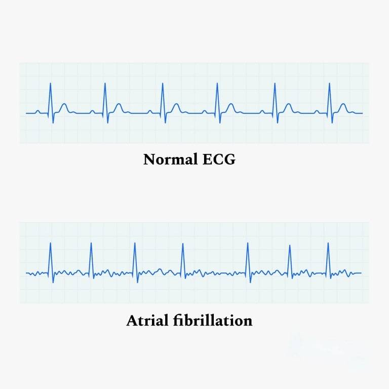 정상 ECG 대 AFib ECG